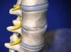 Image of Anterior Lumbar Interbody Fusion