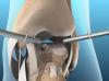 ankle arthroscopy image