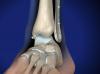 ankle fracture surgery image
