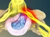 herniated disc image