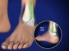 high ankle sprain image