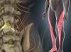 Lumbar Radiculopathy Image