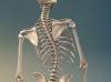 Image of Scoliosis