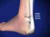 surgery achille srupture image